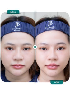 before-after_Fillerปาก-01