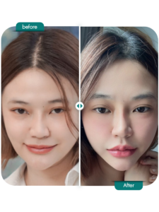 before-after_Fillerปาก-02