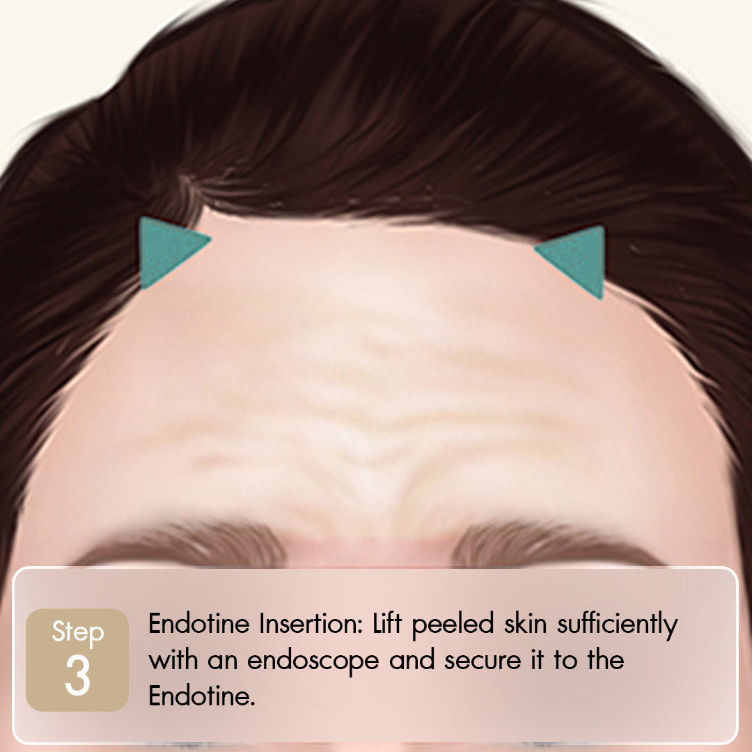 Knoledge Endotine-03