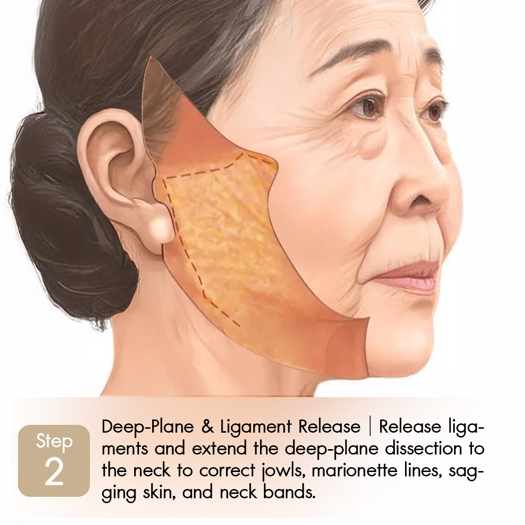 Knoledge Lowerface-02