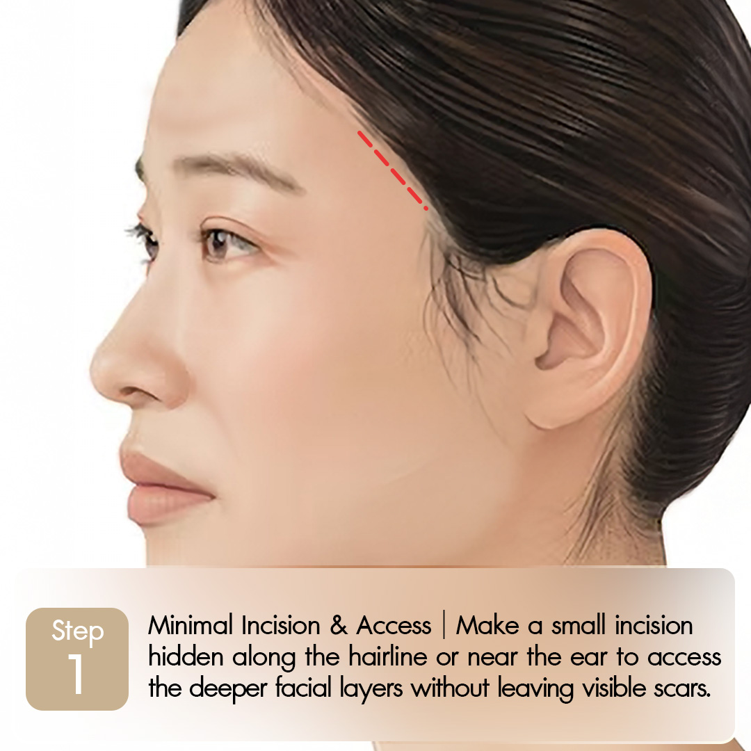 Knoledge Midface-01