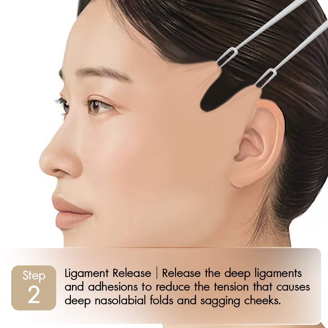 Knoledge Midface-02